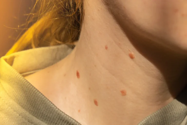 Hautkrebsvorsorge hausarzt homburg melanomscreening